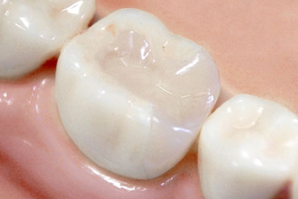 詰め物・被せ物